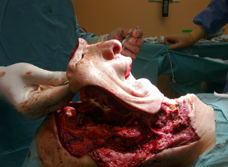 Illustration for article titled Reddit User Documents Facial Transplant in Photos (WARNING: GRAPHIC)